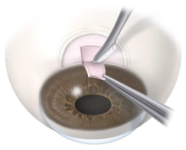 Trabeculectomy | Wyse Eyecare