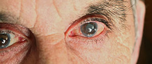 Blepharitis | Wyse Eyecare