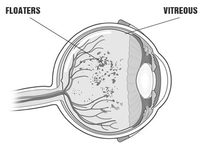 flashes floaters