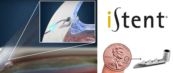 Minimally Invasive Glaucoma Surgery | iStent | Wyse Eyecare | Northbrook