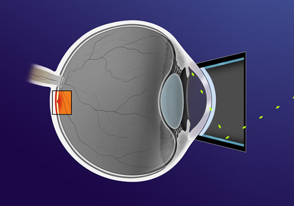 Micropulse Laser Trabeculoplasty (MLT) | Wyse Eyecare | Northbrook