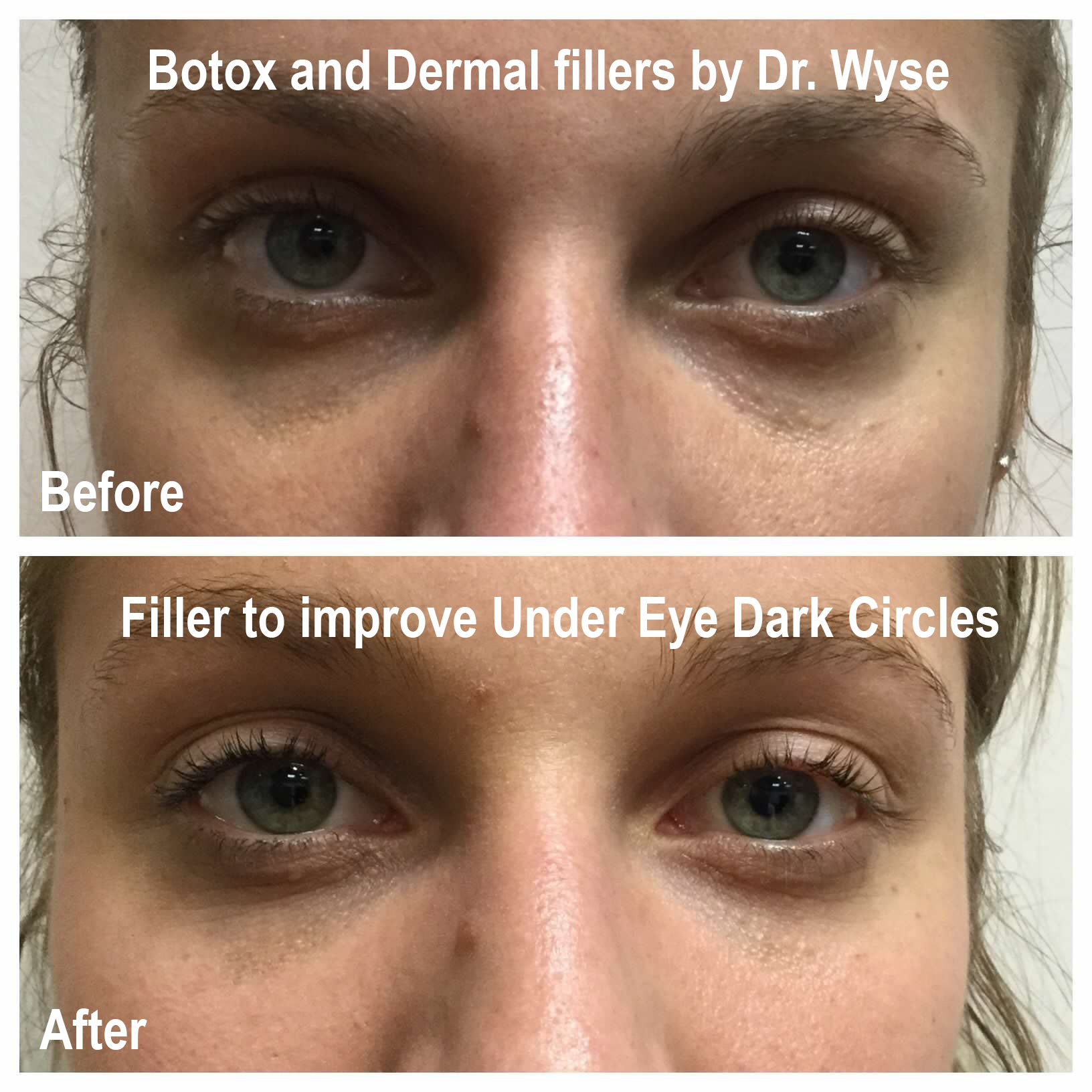 Dermal Fillers by Dr. Wyse
