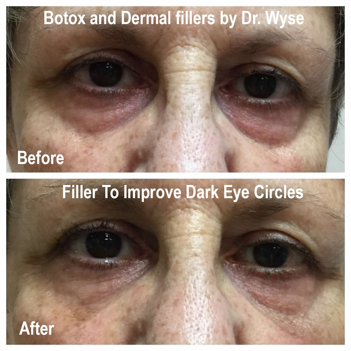Fillers to Improve Dark Eye Circles