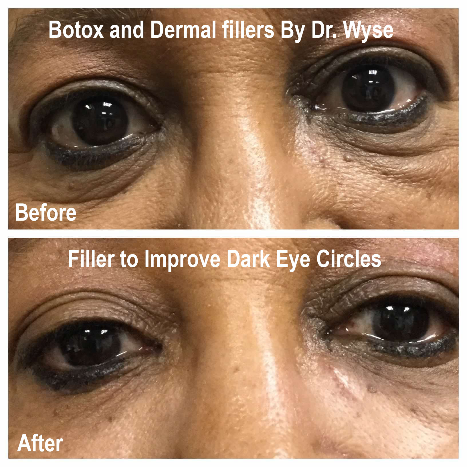 Dark Eye Circles - BOTOX and Dermal Fillers