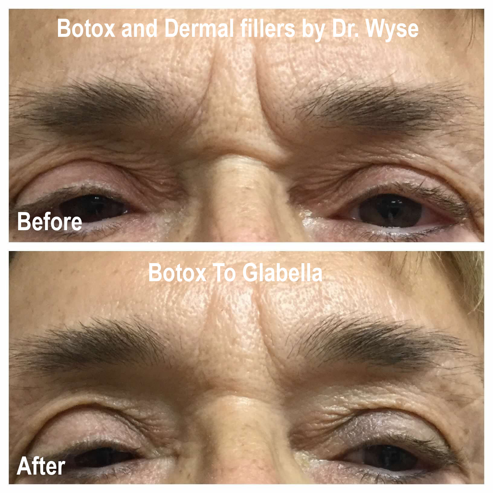 BOTOX to Glabella