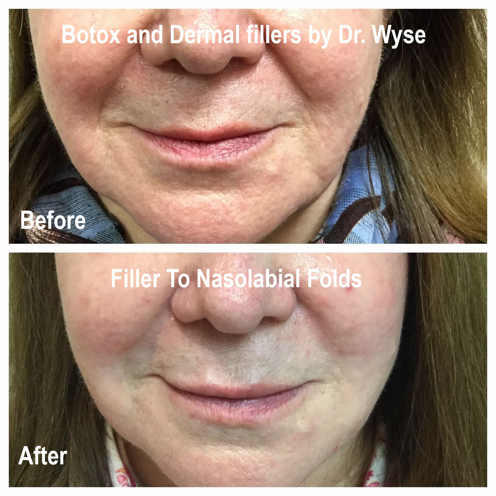 Filler to Nasolabial